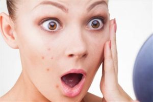 برای لکه های جوش نیاز به لیرز نیست