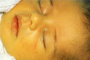 زایمان سزارین احتمال افزایش زردی نوزادان