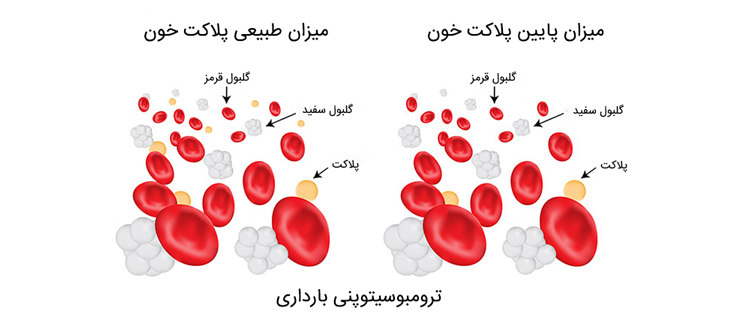 ترومبوسیتوپنی بارداری