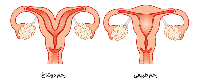 مقایسه رحم دو شاخ و رحم طبیعی