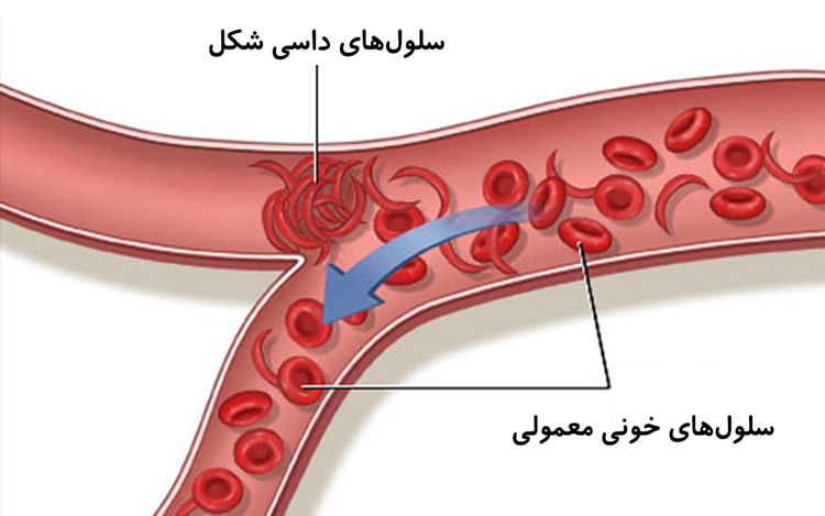 تصویر سلول های داسی شکل و نقش آن در کم خونی