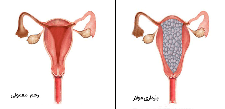 بارداری پوچ یا بارداری مولار