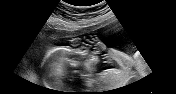 کدام بیماری جنین با سونوگرافی مشخص می شود؟