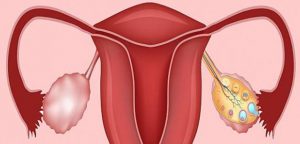 تنبلی تخمدان چه دلایلی دارد؟